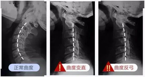 躺上去就爽 1秒立享颈椎 牵引 快感 3分钟后颈椎舒服到爆,骨科医生推荐 央视热播