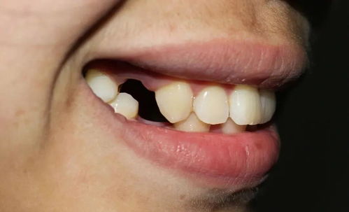 为什么医生都建议你做种植牙,而不推荐镶牙