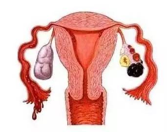 引起卵巢囊肿不孕原因是什么?可以试管促排吗？