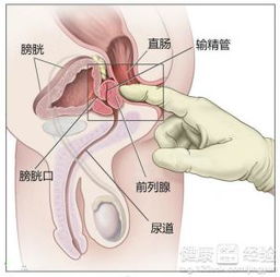 前列腺炎会引发阳痿早泄吗