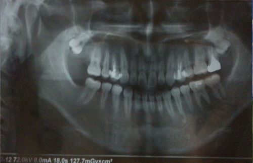 我这科智齿好不好拔,长的旁边去搞的旁边的牙齿疼了 