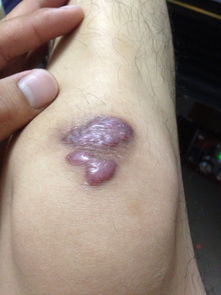 我这种疤痕可以修复吗,膝盖上的是7月7号骑车摔的 