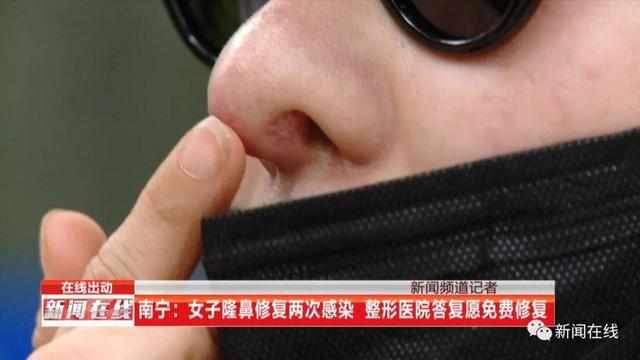 南宁一女子隆鼻修复两次感染,整形医院答复愿免费修复