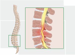 都是腰腿痛,腰椎管狭窄症和腰间盘突出症有什么不同