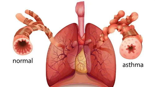 干细胞治疗慢阻肺,帮助人类摆脱令人窒息的疾病