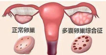 卵巢发育异常可以成功试管助孕吗，会成功怀孕吗？