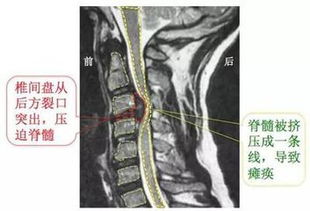 哪些颈椎病不建议手术切除(哪些颈椎病不建议手术切除颈部)