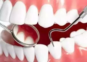 洗牙会导致让牙齿松动或牙缝变大吗 深圳牙齿矫正 