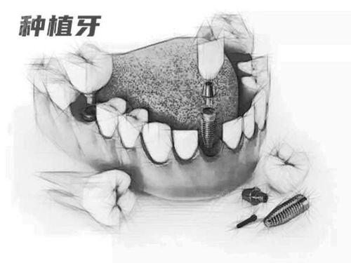 为啥医生跟我说韩国种植牙千万不要做 是韩系种植体不好还是医生想多挣钱