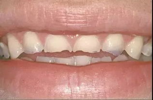 为什么牙齿表面一层层脱落 是缺钙吗
