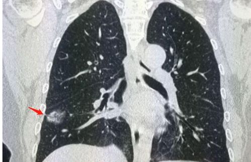 肺体检查出肺结节,担心是恶性 医生 不符合4种条件,且放宽心