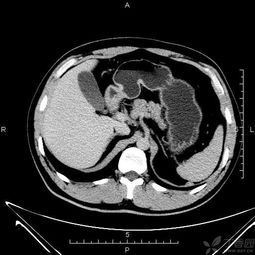 做CT肝脏正常，为什么肝区隐痛(ct检查肝正常)