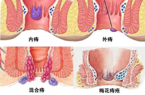 痔疮仍占秋季高发疾病之首 专家 想要远离痔疮要从根源解决问题