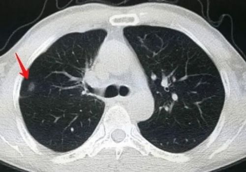 44岁大姐查出7mm肺结节,半年结节逐渐消失,这些做法值得借鉴