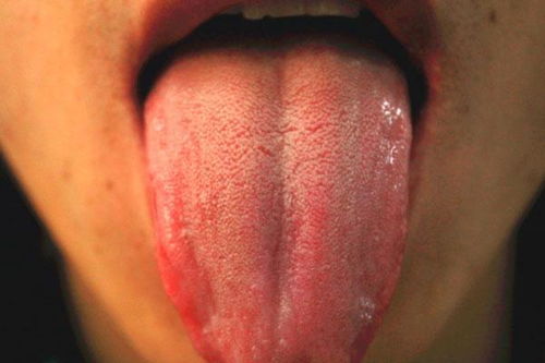 阳后舌头长厚白舌苔(舌头发白是什么原因舌苔发白是怎么办)