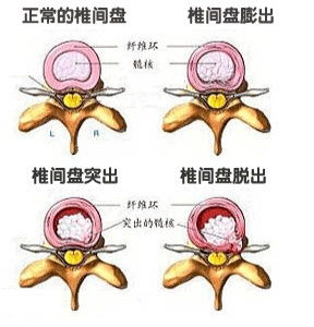 腰椎间盘突出是否只能静养 没有更好的治疗方案了吗 