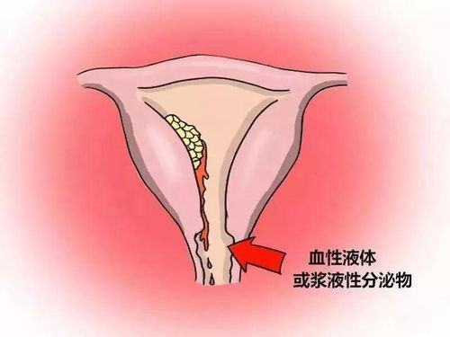 宫颈癌早期症状,70 80 90后女性必看