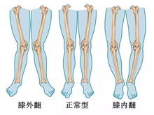 必知 O 型腿及 X 型腿矫正方法总结