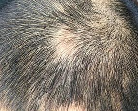 斑秃形成的原因，斑秃是怎样形成的有哪些原因