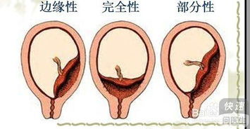 前置胎盘应该怎样卧床 在孕期怎么预防前置胎盘