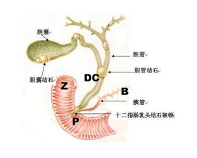 胆囊管结石怎么治 