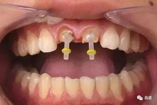 技能丨有关桩核的几个问题, 一位牙医多年临床经验总结 
