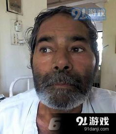 印度男子被插75根针 X光照惊人其竟称不知是何人所为