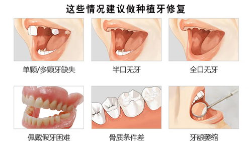 种植牙齿要分几个步骤 种植牙术后如何维护