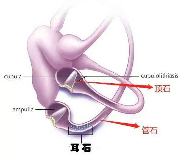 天旋地转为哪般 带您揭开耳石症的面纱