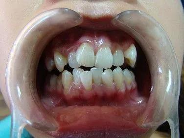 导致牙齿不齐的坑有很多,你入的是哪个坑