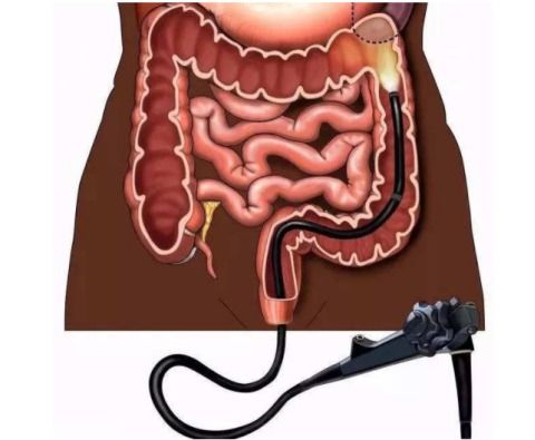 西安大兴医院肛肠盆底外科陈文平 无痛肠镜一定比普通肠镜好