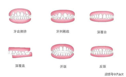 年纪大了就不能箍牙了 8个关于牙齿矫正的谣言,你有听过吗