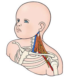 新生儿臂丛神经损伤(临床表现)