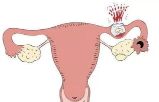 宫外孕，宫外孕有什么症状