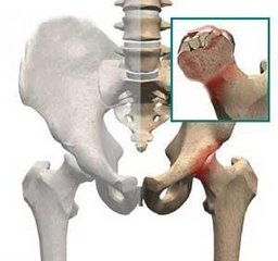 股骨头坏死佳治疗方法