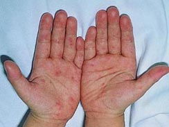 手足口病前期症状 手足口病的前期症状