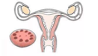 多囊卵巢综合症诊断，多囊卵巢综合症诊断标准