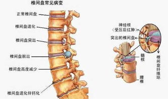 腰椎间盘突出能够自愈吗 