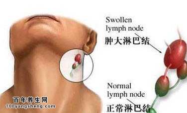 颈部淋巴结核症状，颈部淋巴结核的早期症状是什么