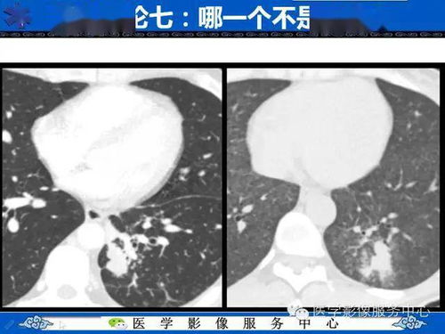 肺癌的影像学鉴别诊断实例 哪些不是肺癌