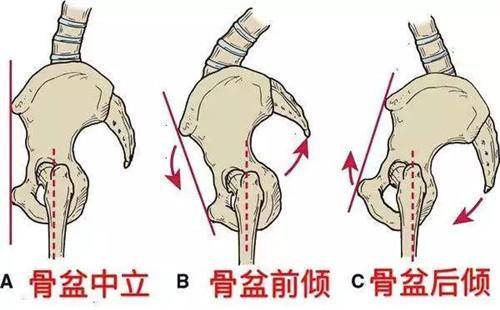 怎么改善骨盆前倾后倾