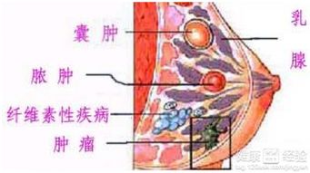 乳腺结节吃什么药