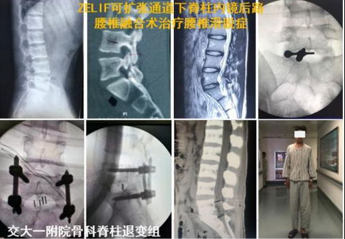 一附院开展西北首例 ZELIF可扩张通道下脊柱内镜后路腰椎融合术