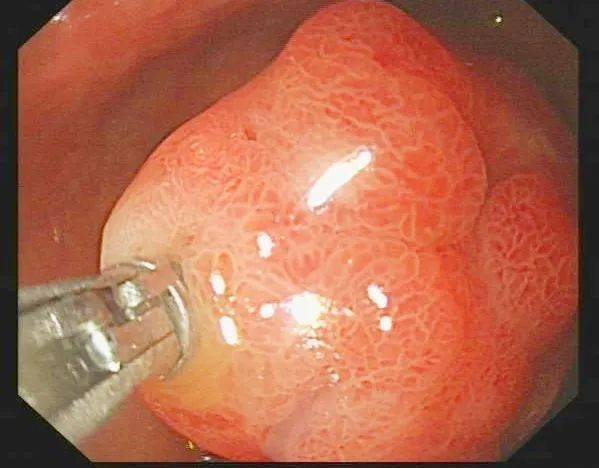 胃镜室采用粘膜下剥离术 ESD 成功切除一例胃窦大息肉
