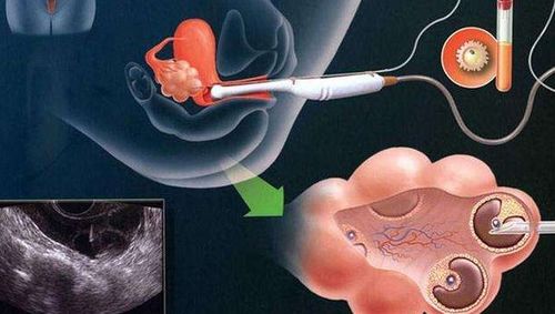 卵巢功能下降可能会有哪些征兆，可以考虑做试管吗？