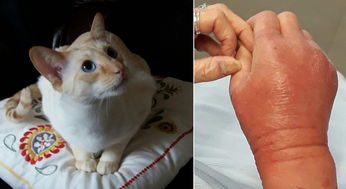 国外65岁奶奶被猫抓伤后昏迷5天