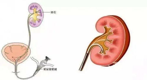 多发肾结石体外碎石6次还没碎完，需要碎石还是做皮肾手术