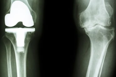 膝盖骨折,打完石膏后一直感觉小腿特涨是什么原因 