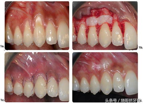 补牙前，牙医洗牙时牙根总渗血是什么原因(补牙前洗牙疼不疼)