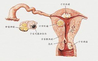 子宫内膜癌的出血特点,子宫内膜癌的主要症状